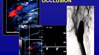 Ultrasound of the Carotid Arteries [upl. by Kcod]