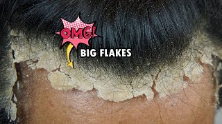 Picking BIG Scalp Flakes Psoriasis Satisfying 745 [upl. by Eizle]