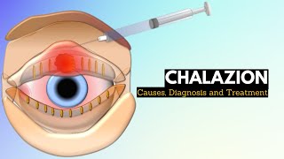 CHALAZION Causes Signs and Symptoms Diagnosis and Treatment [upl. by Fisken]