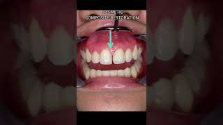 Immediate Fix for GAPS OR SPACES for your front teeth DIASTEMA CLOSURECOSMETIC RESTORATION shorts [upl. by Ailen]