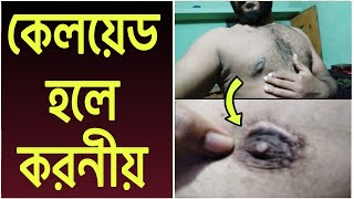 Gynecomastia সার্জারির পর কলোয়েড হলে কি করবেন  keloid Treatment After Gynecomastia Surgery [upl. by Franci]