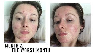 ACCUTANE MONTH 2  Almost Daily Skin Vlog [upl. by Nealy373]