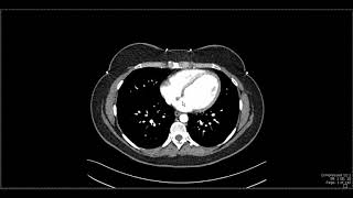 Abdominal Anatomy on Computed Tomography [upl. by Vizzone625]