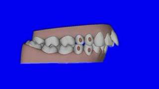 Invisalign Animation [upl. by Yelreveb]