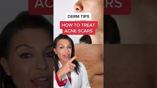 How to Treat Acne Scars According to a Dermatologist shorts [upl. by Siari554]