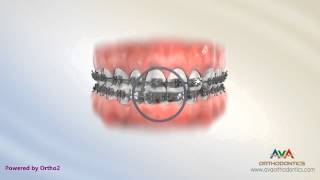 Orthodontic Treatment for Dental Midline  Rubber Bands [upl. by Adrienne593]