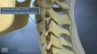 Anterior Subluxation in the Cervical Spine  3D Animation [upl. by Peh109]