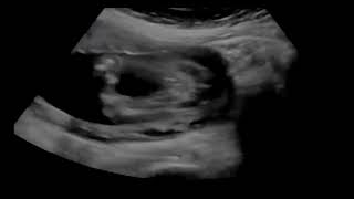 Baby Ultrasound 1 Hour White Noise Dim Screen [upl. by Herbie]