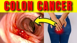 7 New Signs of Colon Cancer  Dont Ignore [upl. by Cohberg]