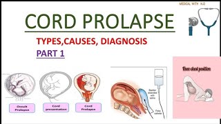 cord prolapseoccult prolapse in hindi types causes diagnosis  complications etccordprolapse [upl. by Fatima929]