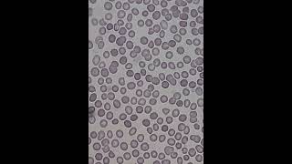 فيديو يوضح خلايا الدم الحمراء المشوكة crenated red blood cells [upl. by Leler991]