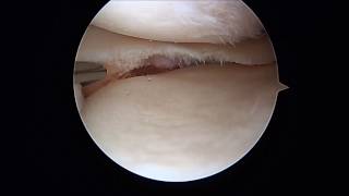 How a Meniscus Tear Is Repaired [upl. by Stila]