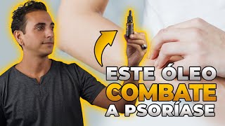 1207 às 20h  Top 5 Óleos Essenciais para Dermatite e Psoríase [upl. by Niffirg]