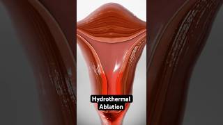 Using heated fluid to stop heavy periods 3D Animation [upl. by Ossie]