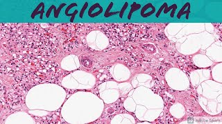 Angiolipoma 5Minute Pathology Pearls [upl. by Dielle915]