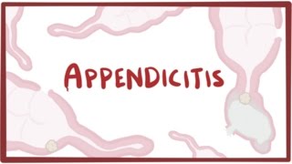 Appendicitis  causes symptoms diagnosis treatment amp pathology [upl. by Giamo]