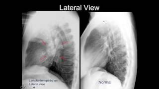 Chest Xray Cases 2 [upl. by Terryl]