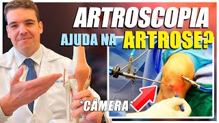 Artroscopia para ARTROSE funciona [upl. by Inor]