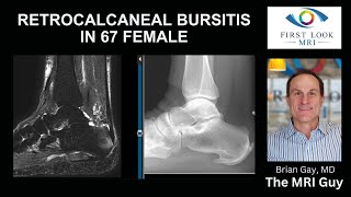 Heel pain from retrocalcaneal bursitis [upl. by Norrie]