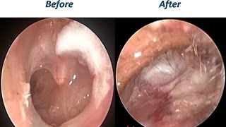 Ear Cleaning 14 days after successful Ear Surgery  Cartilage Tympanoplasty amp Mastoidectomy [upl. by Monson]