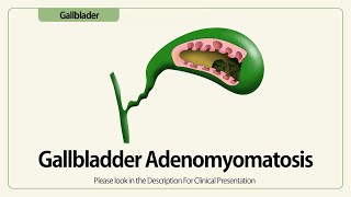 Linear EUS Gallbladder Adenomyomatosis [upl. by Etezzil720]