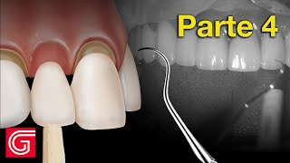 Cómo probar las coronas de zirconia antes de la cementación final – Parte 4 [upl. by Hadihsar]