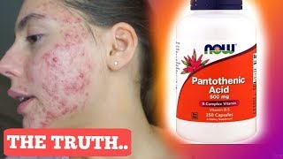 I TOOK PANTOTHENIC ACID FOR ONE MONTH STRAIGHT  THIS IS WHAT ACTUALLY HAPPENED TO MY ACNE [upl. by Atirb]