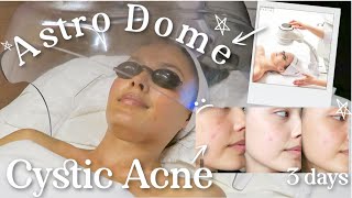 Oxygen Therapy Facial for Breakouts amp Cystic Acne  Skincare Treatments ft OxygenCeuticals [upl. by Engud]