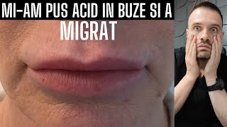 Miam pus ACID HIALURONIC in BUZE si a MIGRAT [upl. by Wendt674]