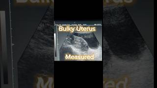 Bulky Uterus  Heterogenous Variable Texture of Uterus  Ovarian Cysts  Adnexa Cyst on Ultrasound [upl. by Olenta37]