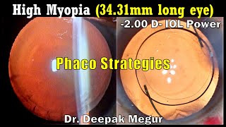 Phacoemulsification Strategies Senile Cataract with Pathological Myopia  Dr Deepak Megur [upl. by Clarkin]