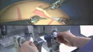 DaVinci Robotic System Prostate Surgery Part 1 [upl. by Akeyla]