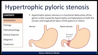 Hypertrophic Pyloric stenosis [upl. by Jamille856]