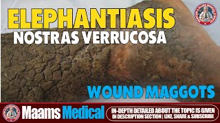 Elephantiasis Nostras Verrucosa and Wound Maggots  Rare Skin Disease [upl. by Gussie]