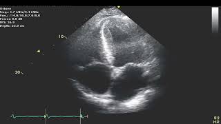 Amyloid Cardiomyopathy with Restrictive Filing [upl. by Ailuj]