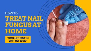 How To Get Rid Of Toenail Fungus  Foot Fungus [upl. by Waddell193]