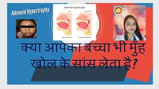 Adenoid Hypertrophy  नाक के पीछे गांठ बच्चों में मुंह खोल के सांस लेना  खराटे बच्चों में [upl. by Dduj]