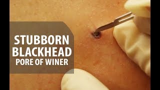 Stubborn Blackhead Removal  Dr Derm [upl. by Arres659]