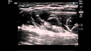 How To UltrasoundGuided Axillary Brachial Plexus Nerve Block Scanning Technique Video [upl. by Susie]