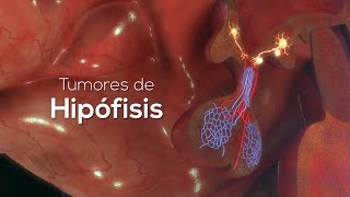 Tumor de Hipófisis o Glándula Pituitaria [upl. by Anurag]