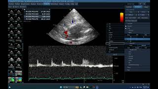 IQ 56 TCD TRANSCRANIAL DOPPLER BRAIN PDH MENINGIOMAICP CPP [upl. by Petie]