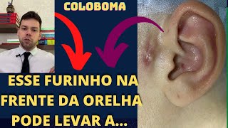 Coloboma Auris ou Sinus pré auricular furinho na orelha com mau cheiro [upl. by Wilkey271]