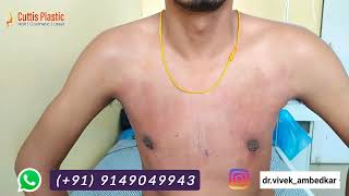 Gynecomastia Surgery Result  Lakhnow  Kanpur Banda Jhansi Panna  Firozabad Sikokabad [upl. by Ocirled]