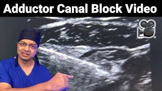 ADDUCTOR CANAL BLOCK Ultrasound Video  Saphenous nerve amp Nerve to Vastus Medialis  NVM Block [upl. by Namurt]