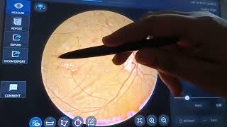 Hard exudates Haemorrhage How Diabetic effect the eyes Fundus examination optometry [upl. by Patton832]