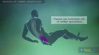 Lumbar Spondylosis Reasons [upl. by Cleodal13]