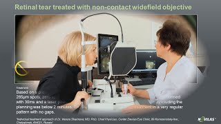 Laser retinopexy Noncontact navigated laser treatment of a retinal tear with Navilas® 577s [upl. by Deppy]