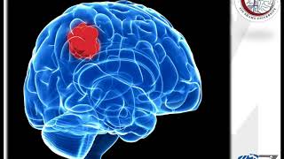 Brain Tumours 1 WHO Classification أورام المخ [upl. by Newell859]