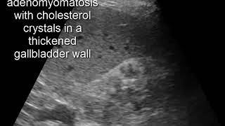 CASE 320 adenomyomatosis with cholesterol crystals in a thickened gallbladder wall [upl. by Uriisa]