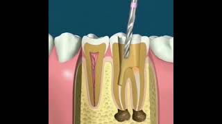 How does Root canal treatment take place🙄 [upl. by Saito]